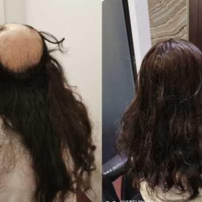 Hair Replacement Singapore&thinsp;